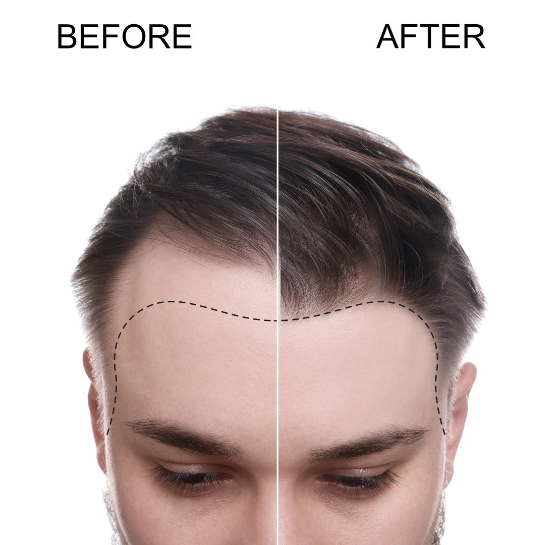 Hair transplant before and after illustration