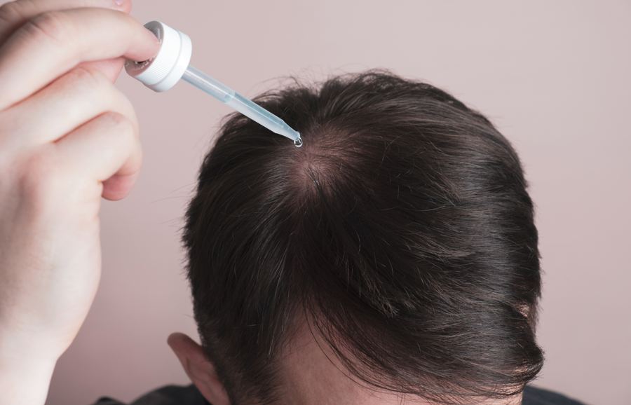 Applying a topical minoxidil and finasteride solution to the scalp with a dropper